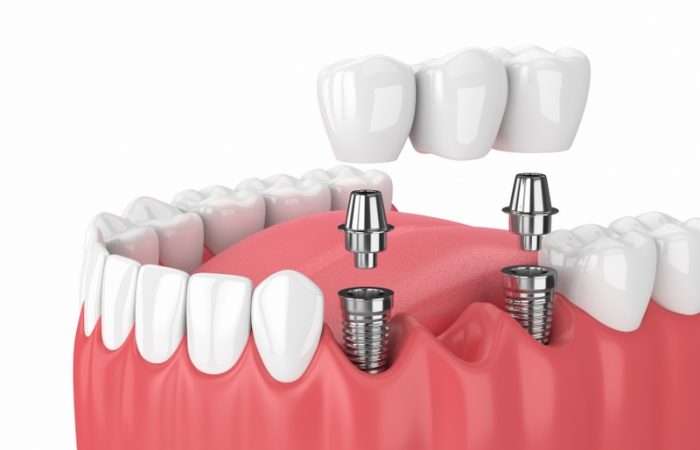 Implant Retained Bridges - Woodbury Park Dental