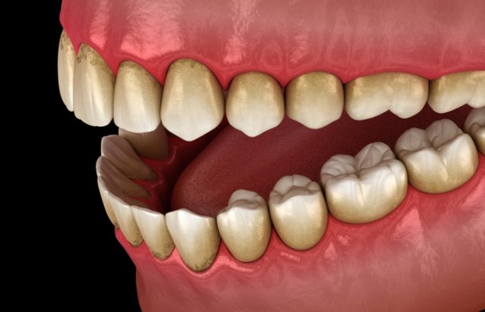 Gingivectomy - Woodbury Park Dental